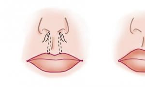 Эффективная пластика верхней губы в операции булхорн